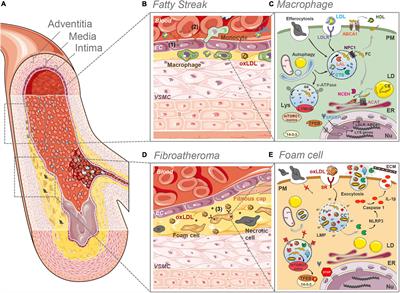 Lysosome (Dys)function in Atherosclerosis—A Big Weight on the Shoulders of a Small Organelle